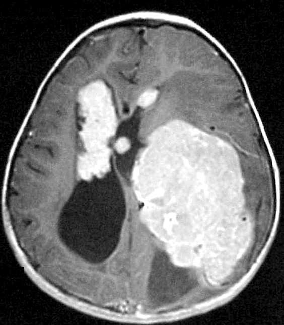 Choroid Plexus Carcinoma